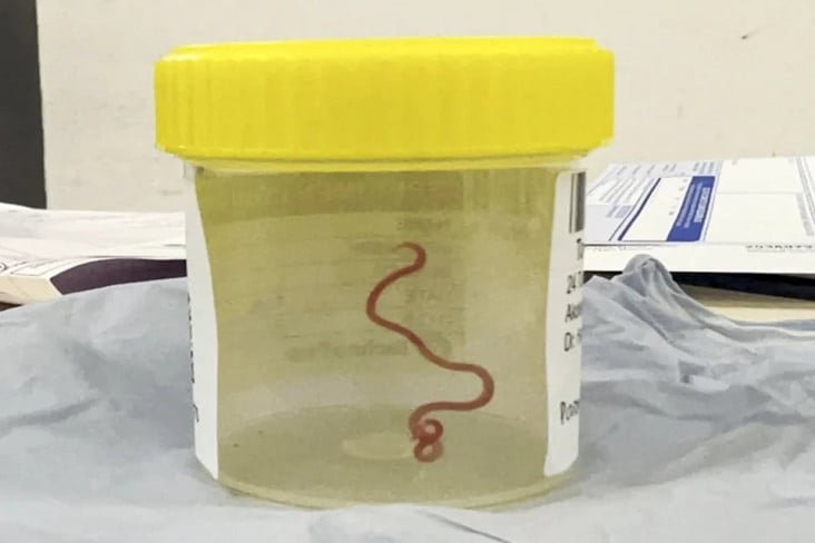 Akibat Telan Organ Ular Mentah, Cacing 18 Cm Bersarang pada Otak Pria Hal ini adalah